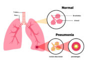 Mengenal Pneumonia Ganda, Penyakit yang Merenggut Nyawa Paus Fransiskus